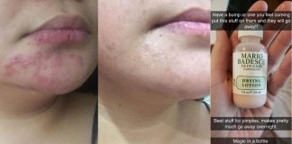 petua kecutkan jerawat