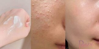 kulit kering dan masalah jerawat