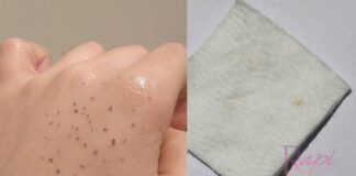 Hilangkan Blackhead Dan Whitehead