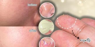 Teknik Skin Gritting